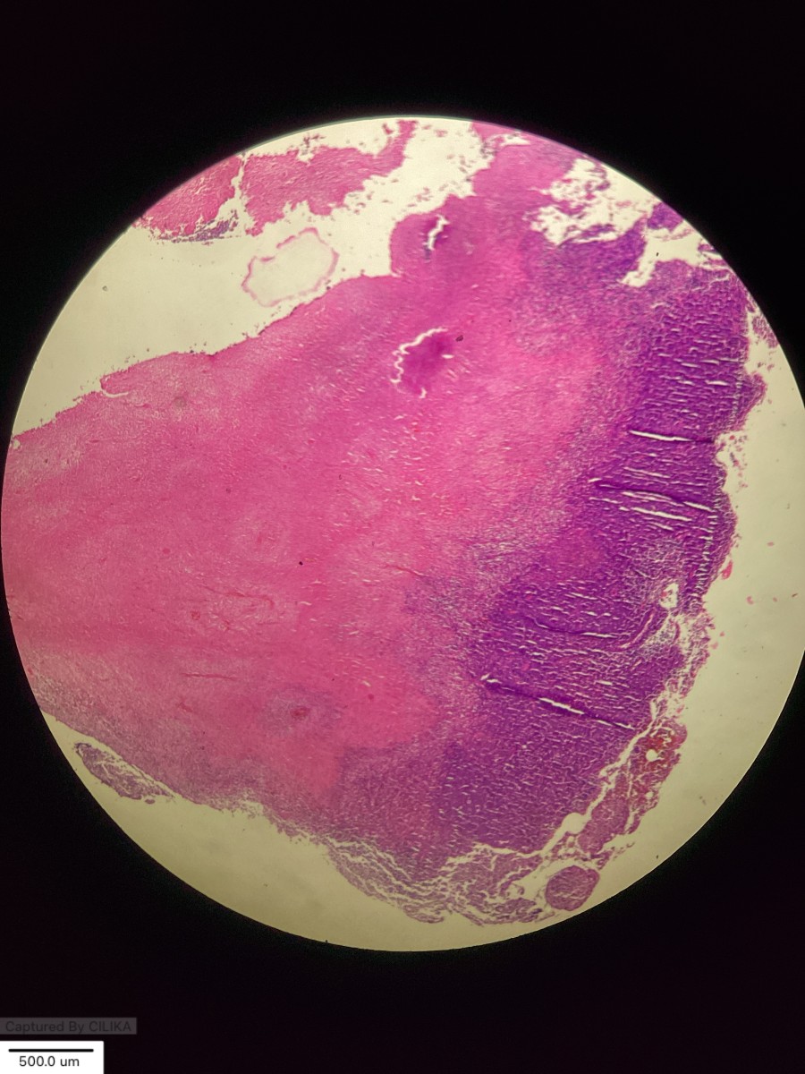 Necrotizing Lymphadenitis of unknown etiology