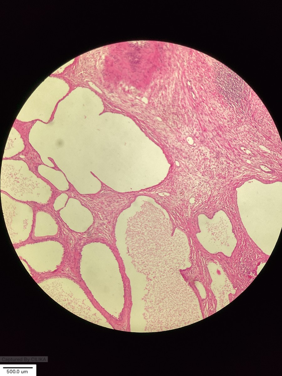Multilocular cystadenoma - The “Bubble Wrap” of the Prostate !