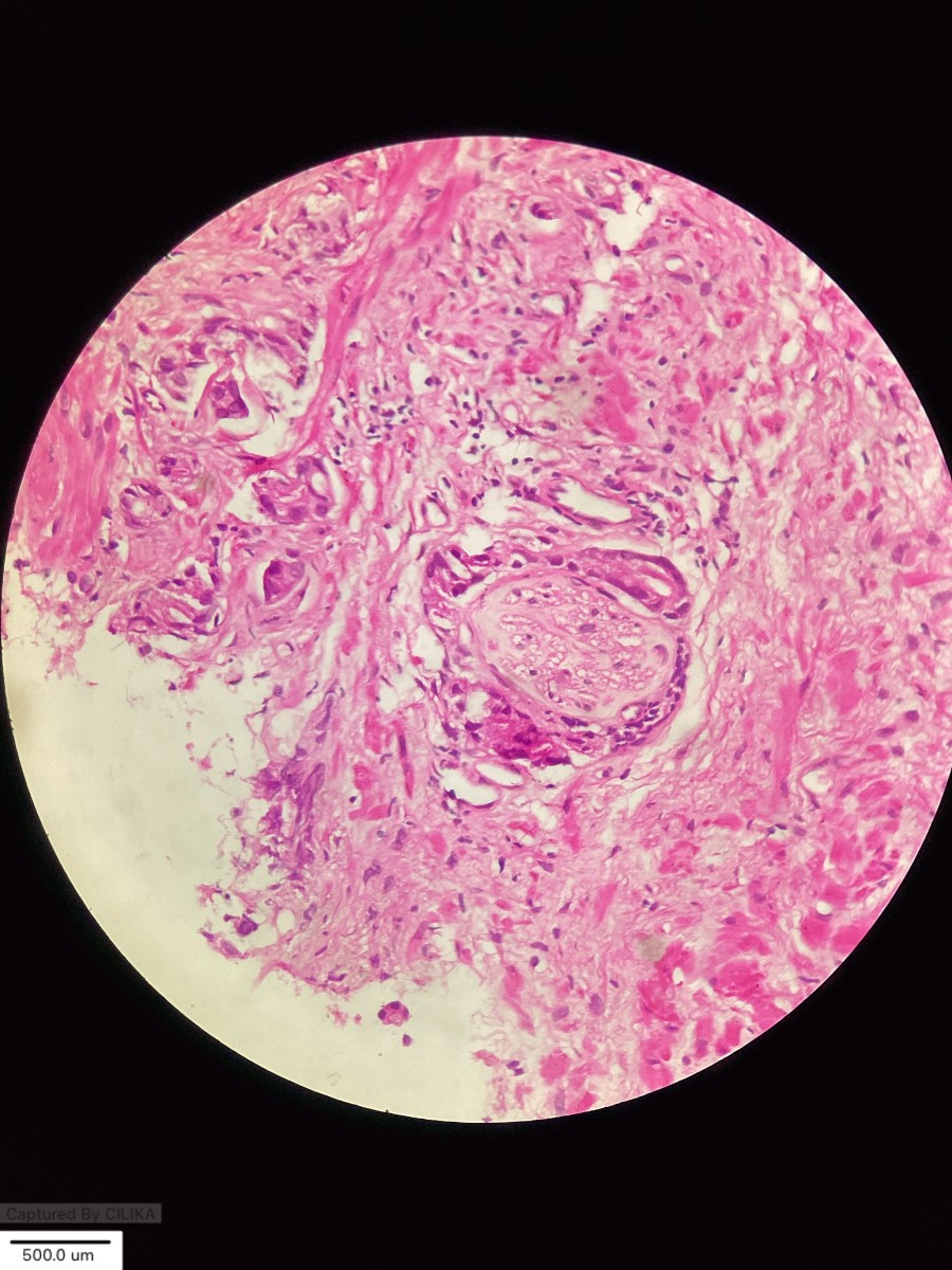 👽”Perineural Invasion- The Tumor’s Shortcut to Trouble!”