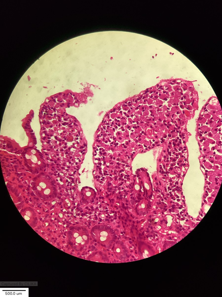 Whipple Disease - The Rare Bug When The Gut Glows PAS Positive and the JR Pages the Wrong Whipple! 😅😅😅