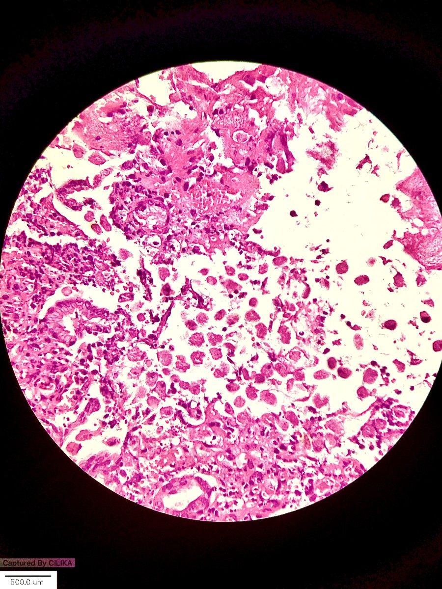 “Amoeba with attitude spotted - Malignancy Politely Excused.”